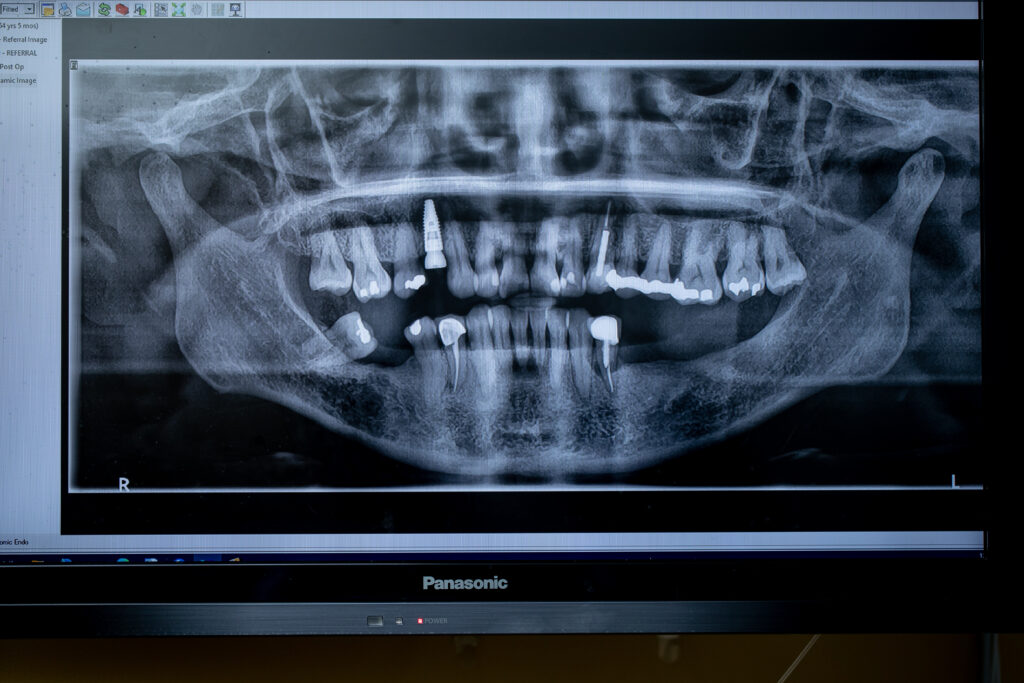 3D image of teeth including dental implants