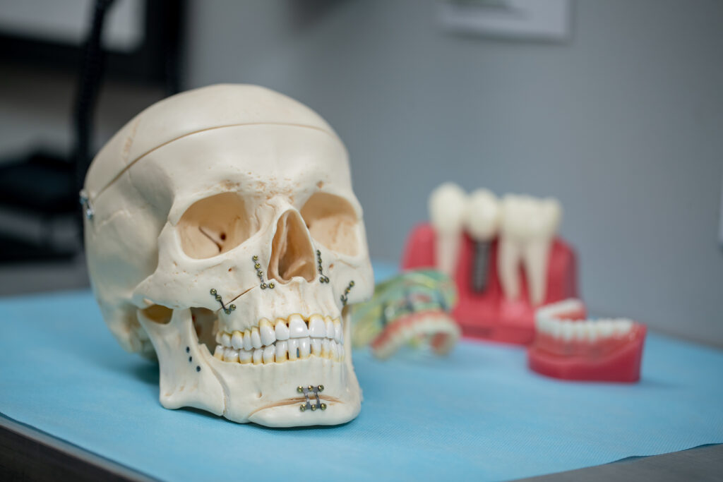model of skull and dental implants
