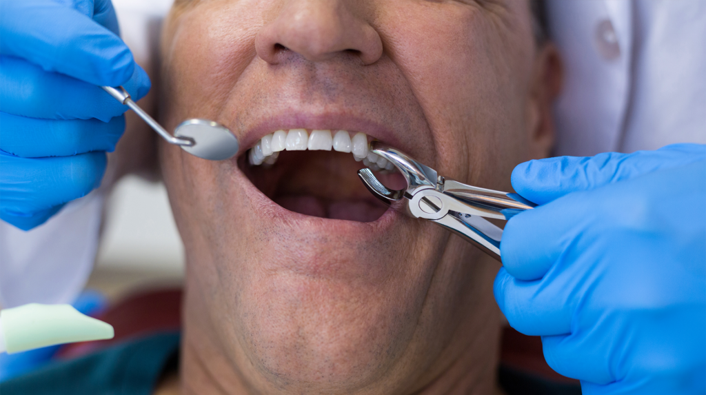 man with surgical pliers in his mouth to extract a tooth